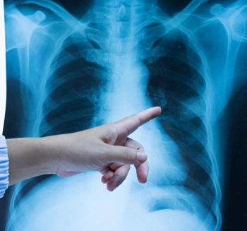 La radiografía se usa para el diagnóstico de la atresia esofágica