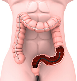 El colonoscopio se inserta a través del recto hasta el intestino grueso.