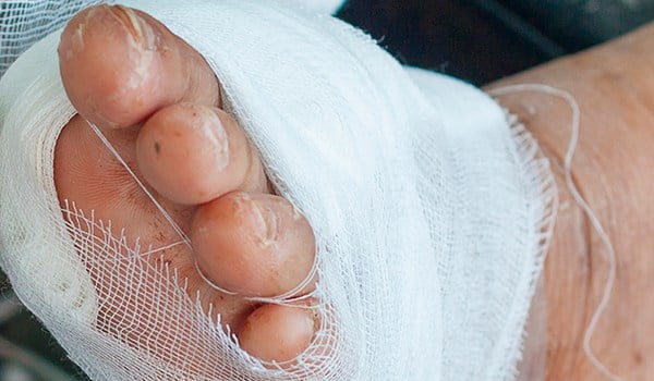 Experto Universitario en Heridas Vasculares en el Miembro Inferior y Pie Diabético, Heridas y Lesiones de Difícil Cicatrización