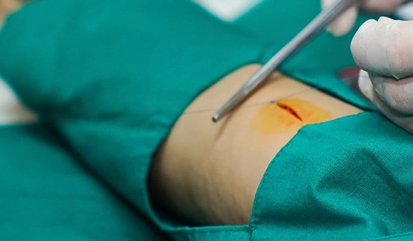 Curso Universitario en Enfermería Quirúrgica: Actuación Integral en Cirugía Menor