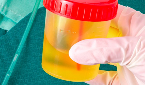 El proceso analítico integral de muestras urinarias