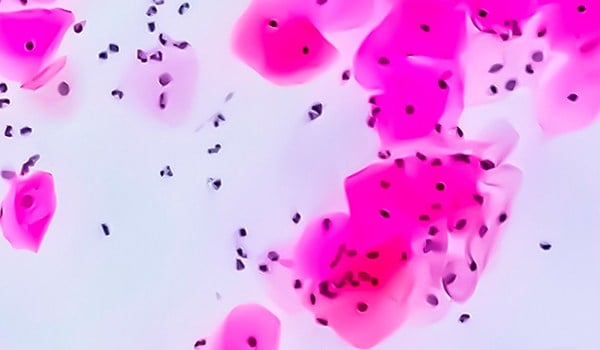 Patologías oncológicas en ginecología