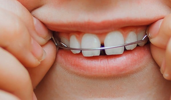 Ortodoncia en atención primaria desde la prevención hasta la intervención temprana