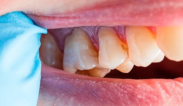 Patología oral para higienistas