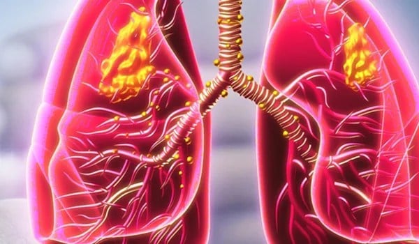 Marcadores moleculares en cáncer de pulmón
