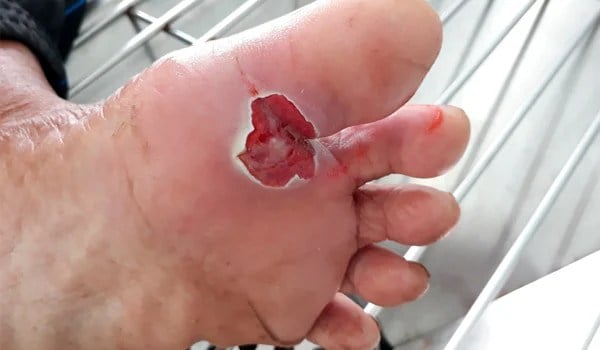 Experto Universitario en Deterioro de la Integridad Cutánea, Úlceras y Heridas