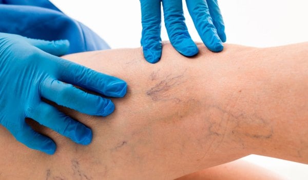 Curso Superior Universitario en Flebología