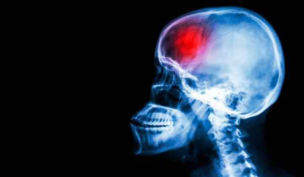 Curso internacional en traumatismo cráneo-encefálico. Enfoque multidisciplinar