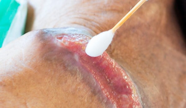 Experto universitario internacional en enfermería en heridas vasculares en el miembro inferior y lesiones de difícil cicatrización