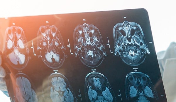 Curso Superior Universitario en Auxiliar de Enfermedades Neuro-degenerativas