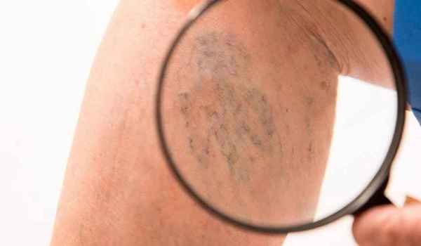 Curso Superior Universitario en intervenciones de enfermería en trastornos vasculares