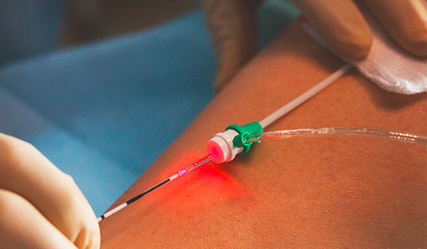 Máster de Formación Permanente en Enfermería Vascular: Úlceras y Patologías Periféricas