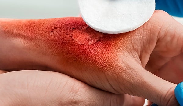 Experto Universitario en Abordaje y Atención Clínica de las Quemaduras