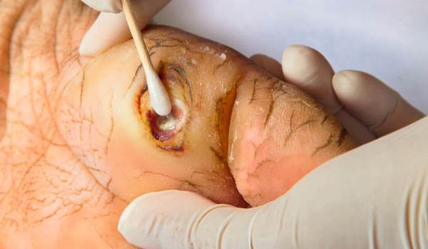 Curso Superior Universitario en actualización en heridas crónicas