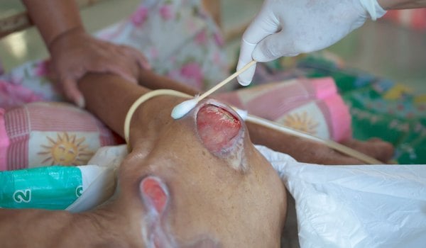 Curso Superior Universitario en Atención y cuidados en lesiones tisulares: úlceras, heridas crónicas y quemaduras