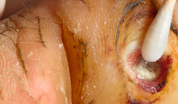 Curso de Actualización en Heridas Crónicas