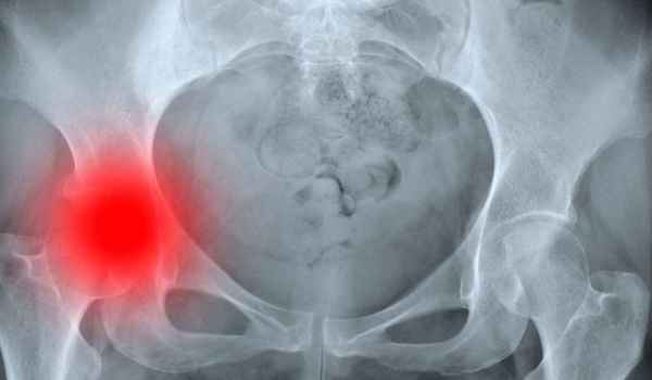 Curso de Fractura de cadera en el anciano. Cuidados de enfermería