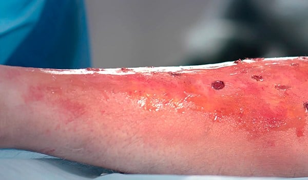 Experto Universitario en Deterioro de la Integridad Cutánea, Úlceras y Heridas