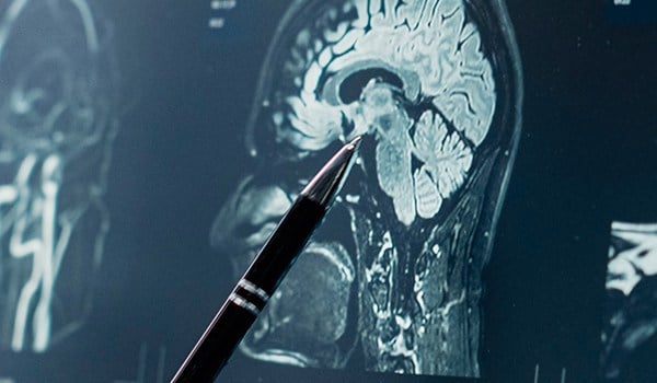 Máster de Formación Permanente en Neuropsicología para Enfermería