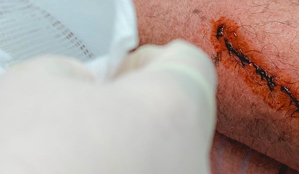 Máster de Formación Permanente en Atención Clínica en Lesiones Cutáneas Crónicas