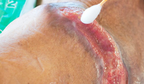 Máster de Formación Permanente en Enfermería de Úlceras Vasculares y Heridas Complejas