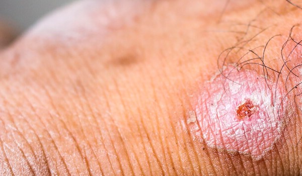 Curso Universitario en Aspectos Nutricionales Relacionados con las Úlceras y las Lesiones de la Piel