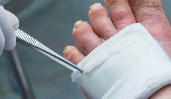 Curso Universitario en Proceso de Atención de Enfermería a Pacientes con Heridas Crónicas