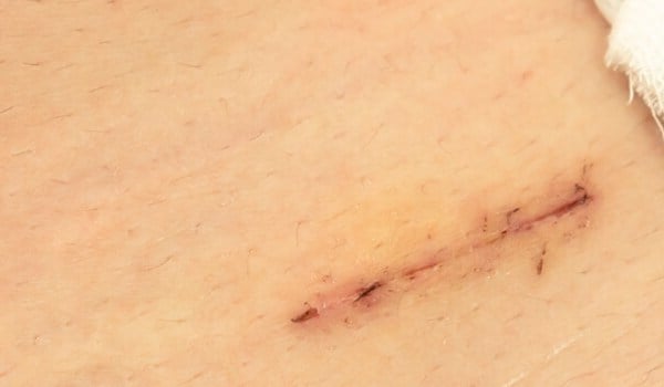 Curso de Fundamentos Aplicados a las Suturas y Apósitos