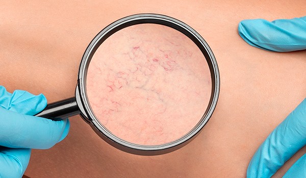 Curso de Intervenciones de Enfermería en Trastornos Vasculares