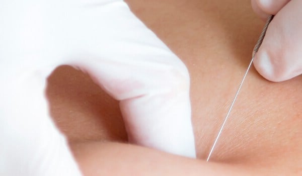 Curso de Puntos Gatillo para Fisioterapeutas