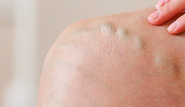 Experto Universitario en Alteraciones Vasculares y Arteriales