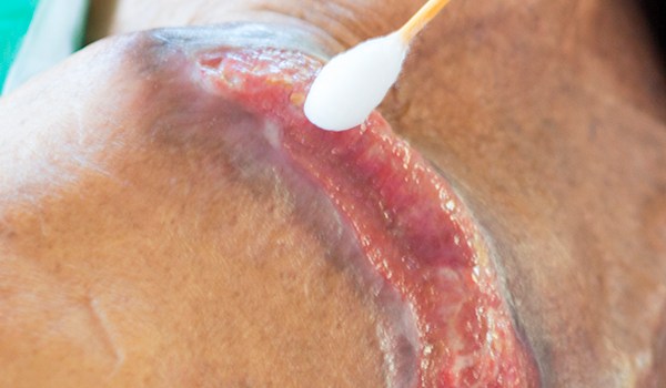 Curso Universitario en Inducción al Proceso de Atención de Enfermería a Pacientes con Úlceras por Presión