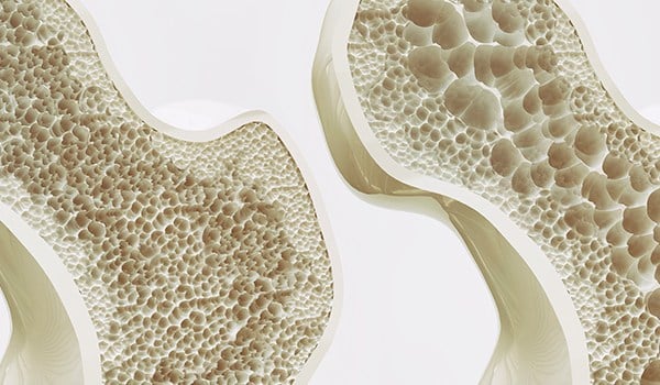 Curso Universitario en Inducción al Manejo Médico de la Osteoporosis