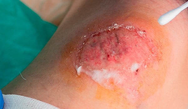 Máster de Formación Permanente en Cuidados de Heridas Crónicas