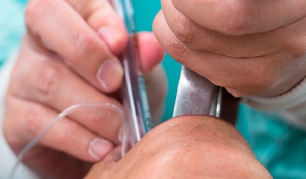 Curso Universitario en Secuencia de la Intubación Rápida (SIR)