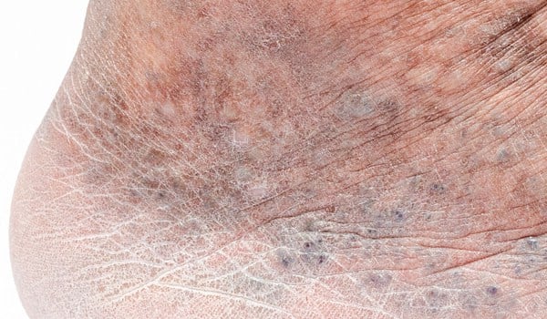 Curso Universitario en Tratamiento de Telangiectasias en Pie y Tobillo