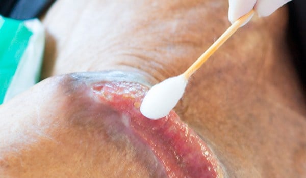 Curso Universitario en Prevención de las Úlceras por Presión en UCI