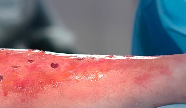 Curso de Atención y Cuidados en Lesiones Tisulares: Úlceras, Heridas Crónicas y Quemaduras