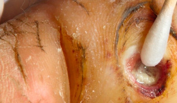 Curso de Heridas Crónicas. Actualización Clínica