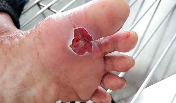 Experto Universitario en Deterioro de la Integridad Cutánea, Úlceras y Heridas