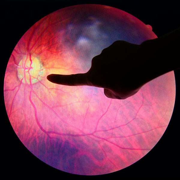 Actualización médica en retinopatía diabética