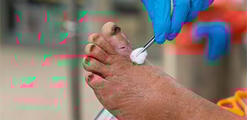 Curso Gratis de Preparación y Control del Lecho de la Herida: Métodos y Técnicas de Desbridamiento