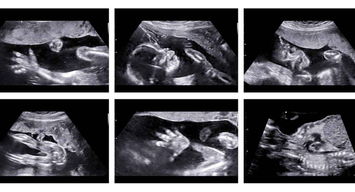 Diagnóstico prenatal de anomalías congénitas fetales